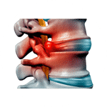 Hernia-discal