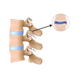 sindrome-facetario